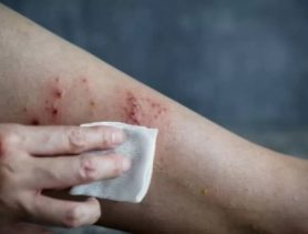 В Минздраве рассказали, дойдет ли оспа обезьян до Беларуси