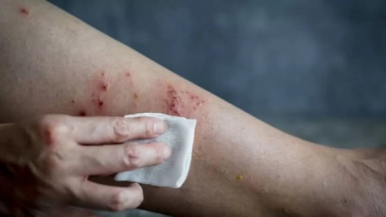 В Минздраве рассказали, дойдет ли оспа обезьян до Беларуси
